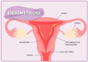 Endometriose Imagem SCOPE