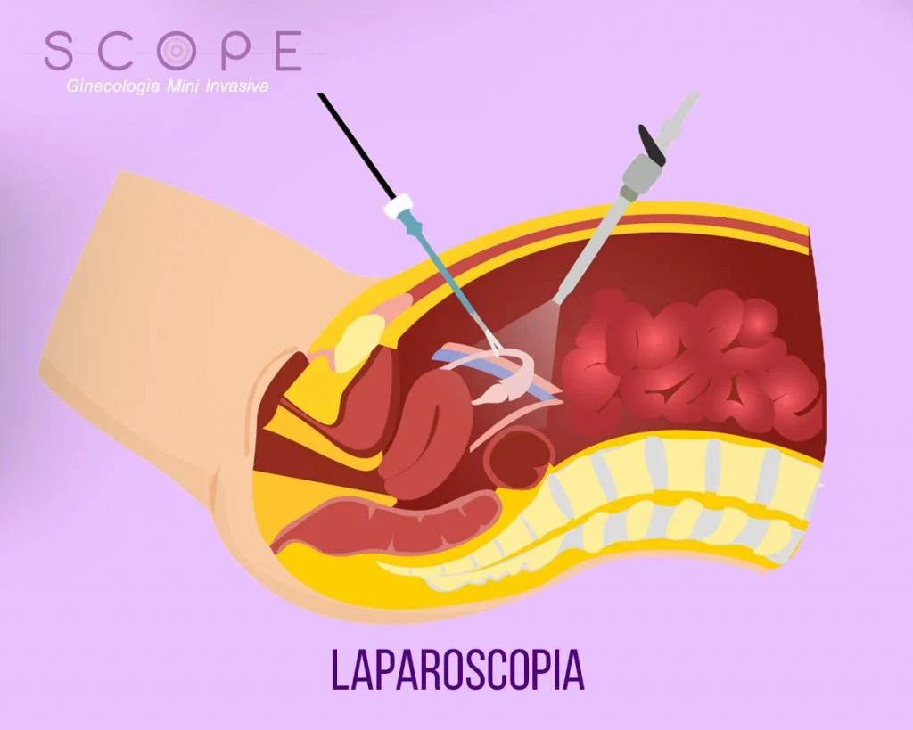 A importância de uma boa recuperação pós-laparoscopia!