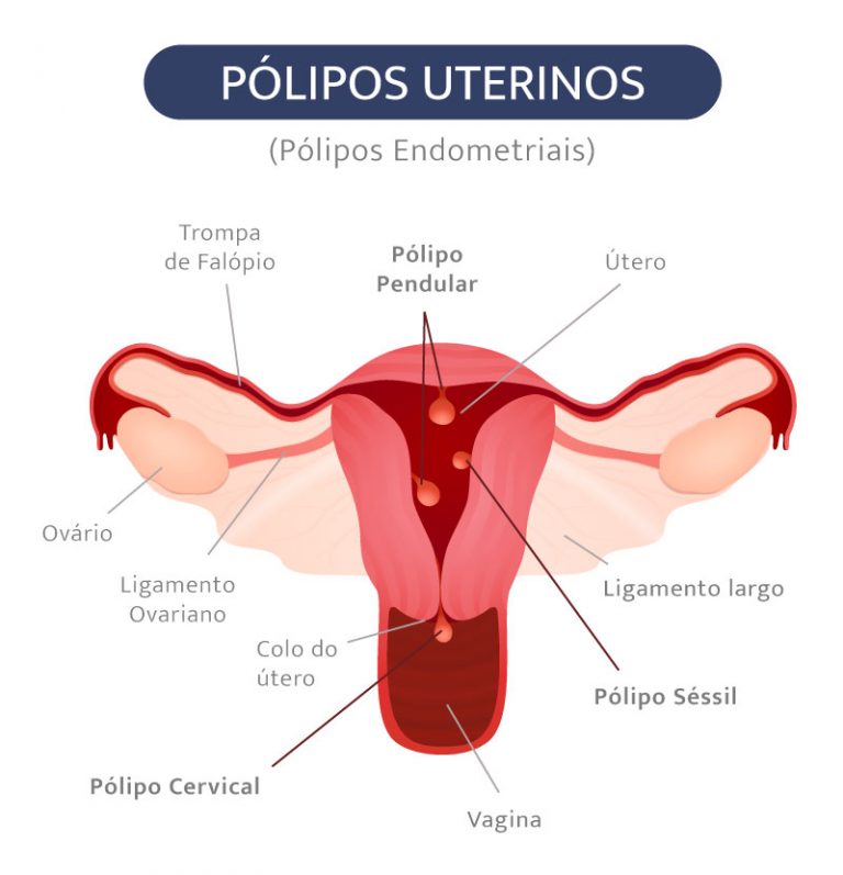 P Lipo Endometrial Scope Ginecologia